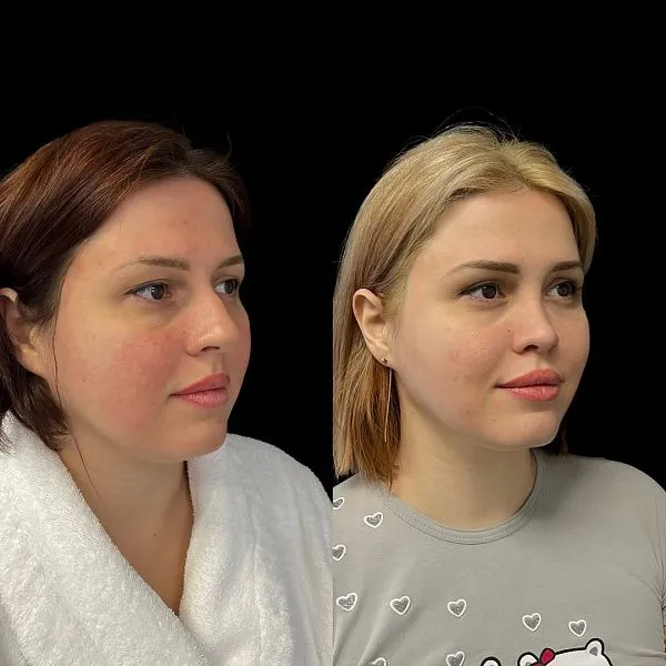 Ринопластика
