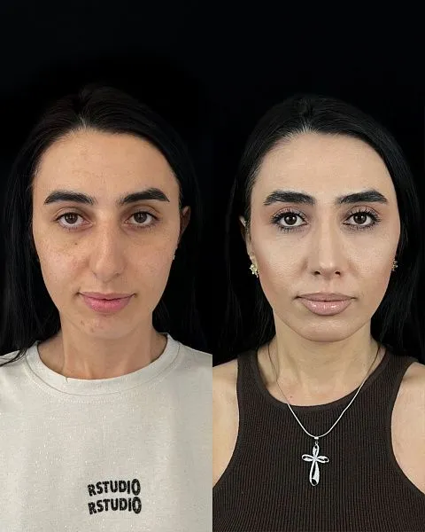 Ринопластика