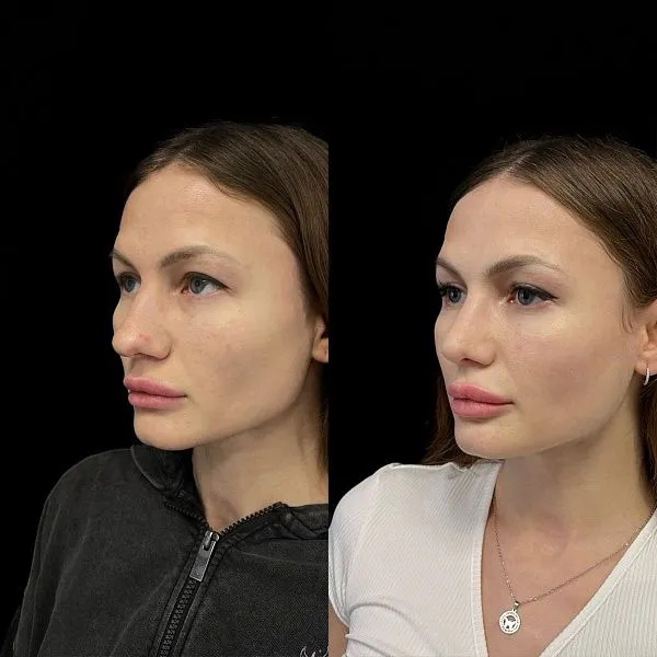 Ринопластика