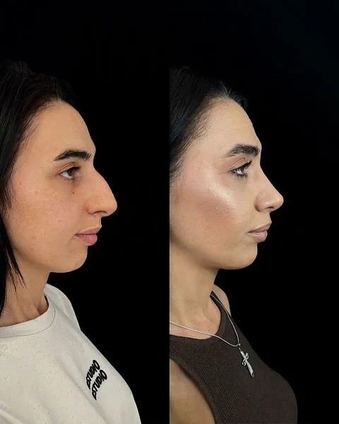 Ринопластика