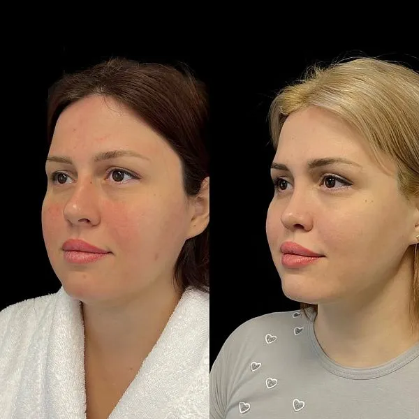 Ринопластика