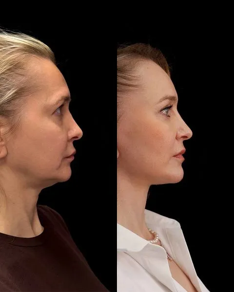 Блефаропластика