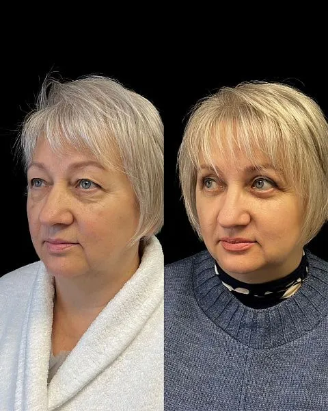Блефаропластика