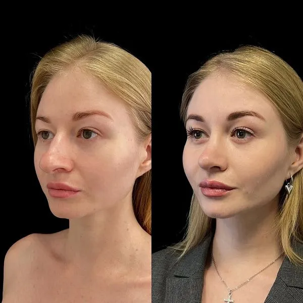 Ринопластика