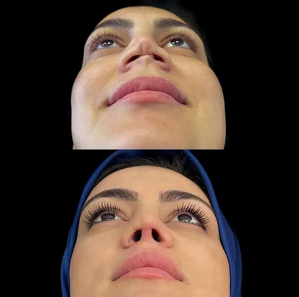Ринопластика