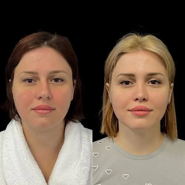 Ринопластика