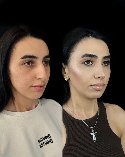 Ринопластика