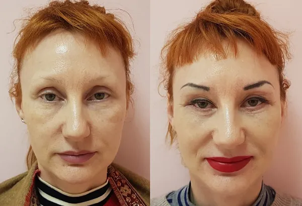 Пластика лица и шеи