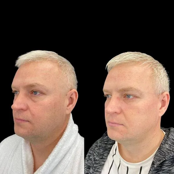 Блефаропластика