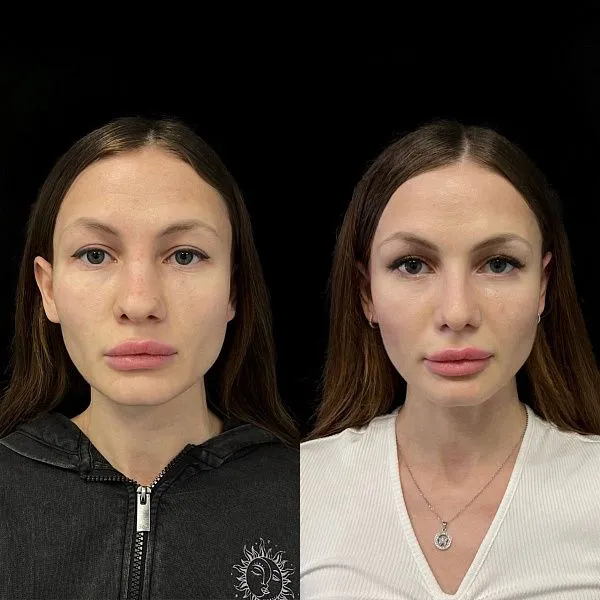 Ринопластика