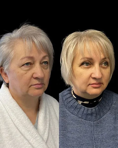 Блефаропластика