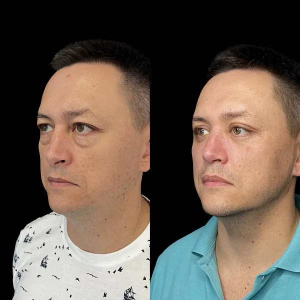 Блефаропластика