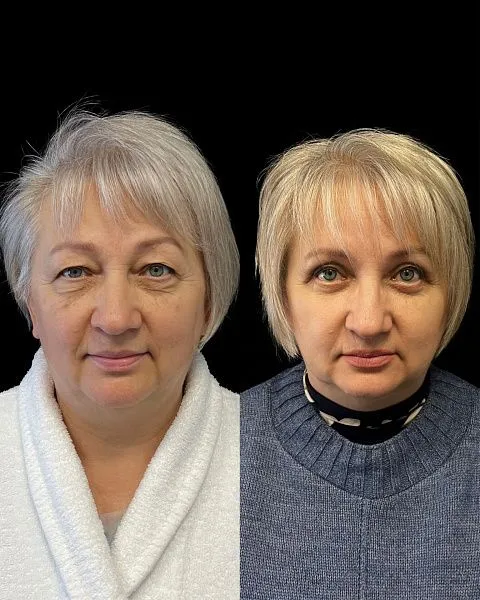 Блефаропластика