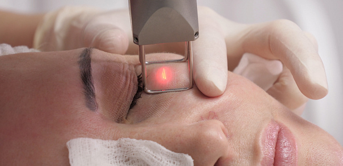 Как проходит процедура лазерной шлифовки лица