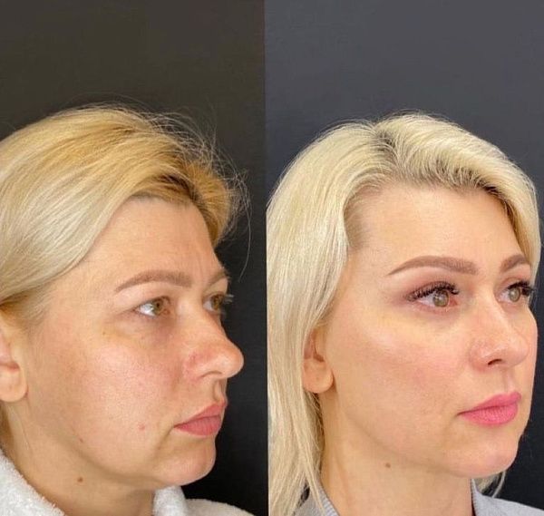 Липосакция лица