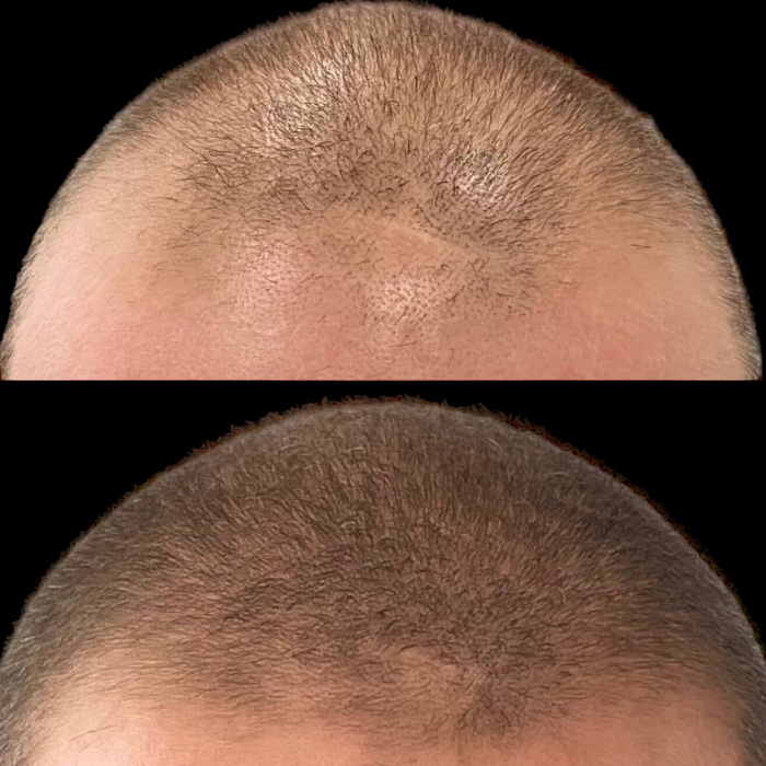 Результаты мезотерапии для волос